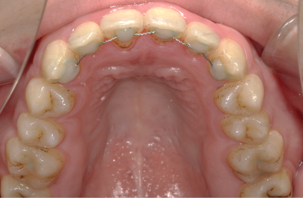 術後④：上顎口腔内