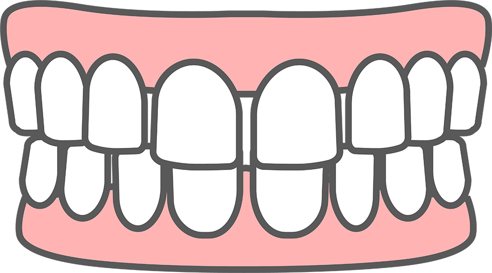 すきっ歯とは？