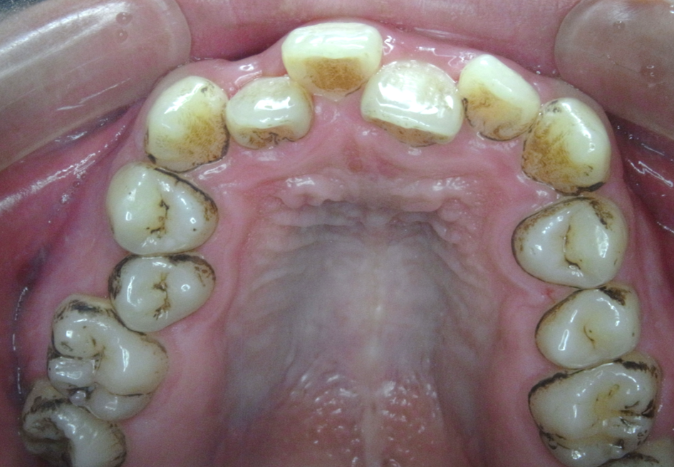 術前④：上顎口腔内