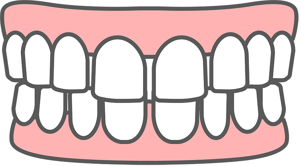すきっ歯（空隙歯列）