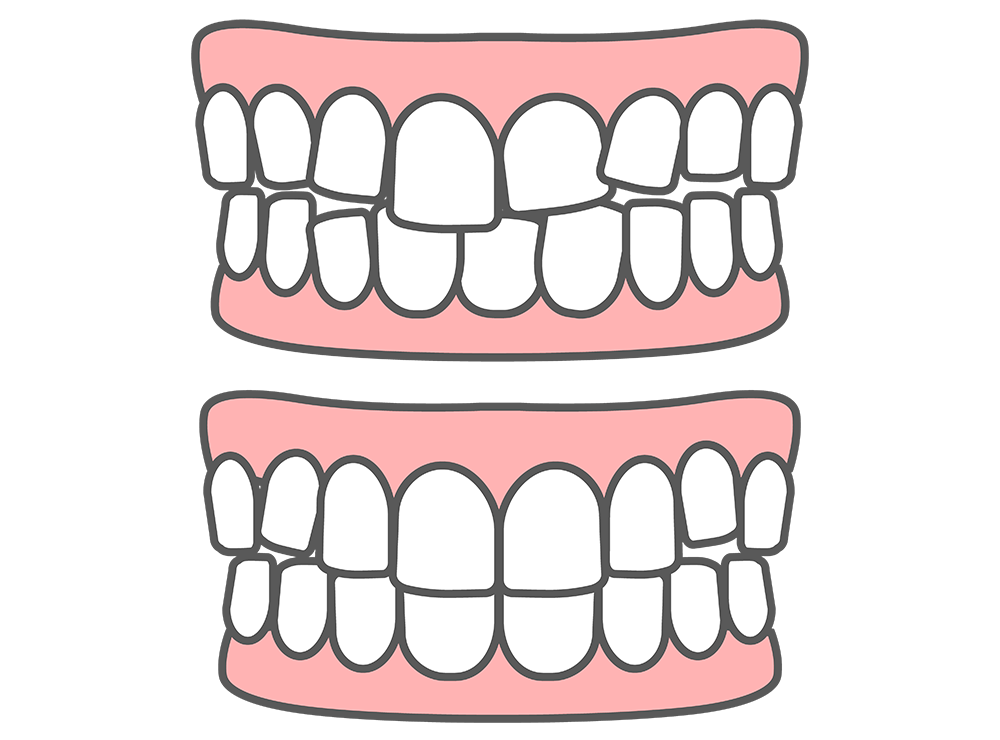 八重歯・歯のガタガタ