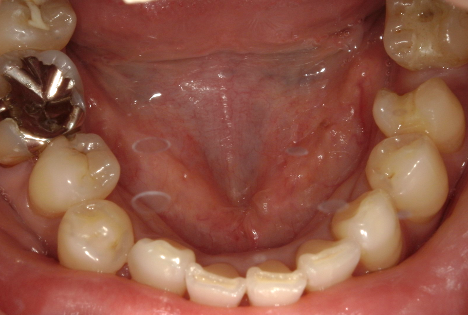 術後④：上顎口腔内