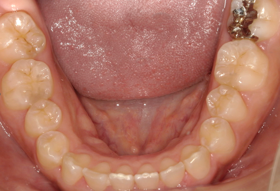 術後⑤：下顎口腔内