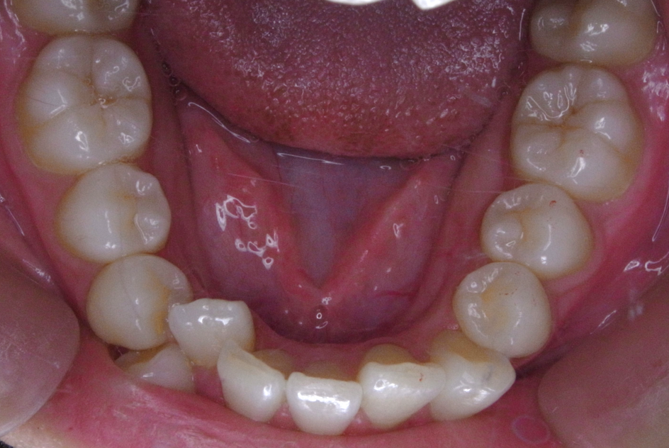 術後⑤：下顎口腔内