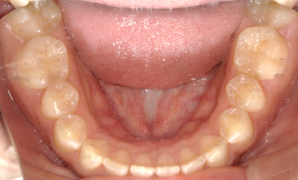 術前⑤：下顎口腔内
